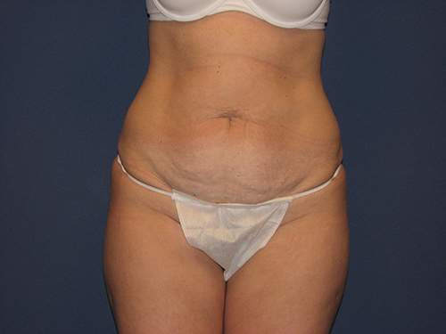 https://www.dreyfussplasticsurgery.com/wp-content/uploads//2016/12/abdominoplasty--2040.jpg